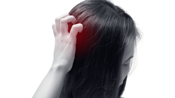 Painful, Sensitive Scalp indicated by a red zone